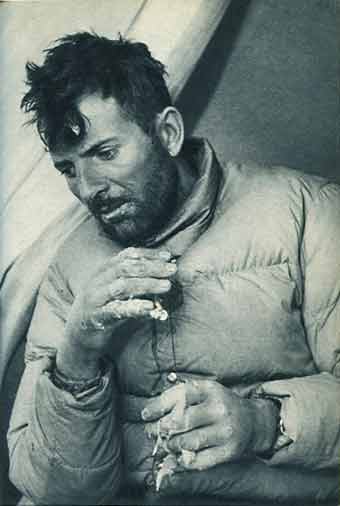 
But Victory Is Ours - Maurice Herzog Showing His Frost Bitten Hands - Annapurna by Maurice Herzog book

